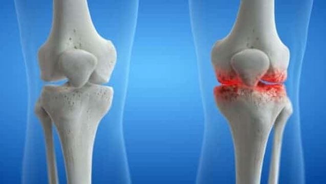 gonarthrose genou remede