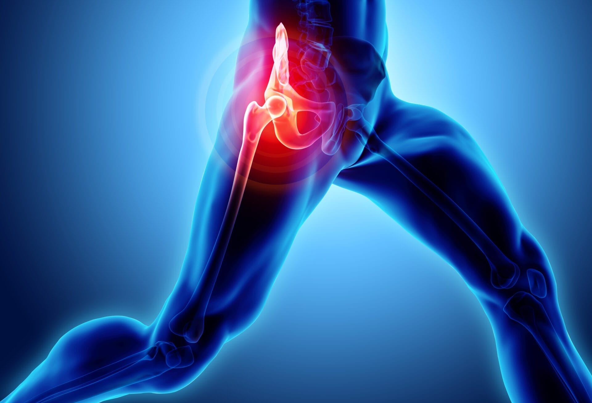 Comprendre et Gérer l'Arthrose de la Hanche